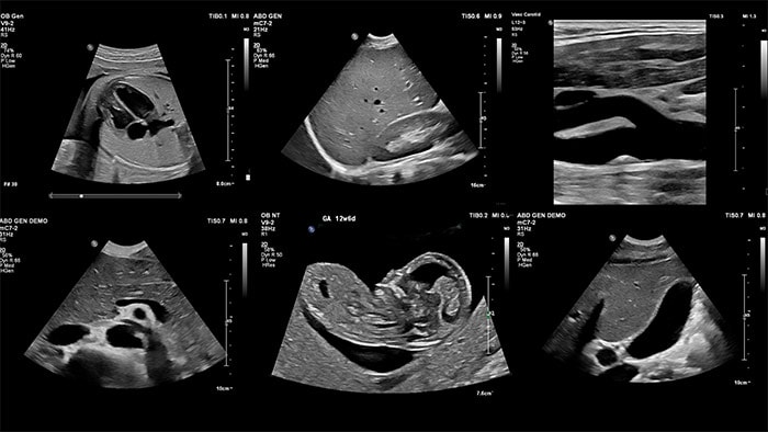 A series of images showing the different stages of an ultrasound.